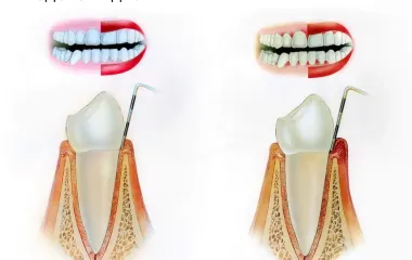 Гінгівіт - причини, симптоми, діагностика та лікування